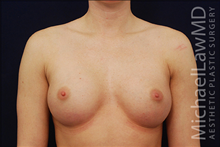 Breast Augmentation After Photo by Michael Law, MD; Raleigh, NC - Case 23786