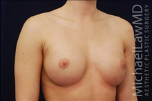 Breast Augmentation After Photo by Michael Law, MD; Raleigh, NC - Case 23786