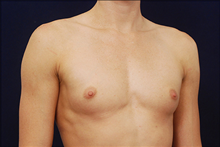 Breast Augmentation Before Photo by Michael Law, MD; Raleigh, NC - Case 23786