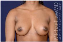 Breast Augmentation After Photo by Michael Law, MD; Raleigh, NC - Case 28376
