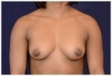 Breast Augmentation Before Photo by Michael Law, MD; Raleigh, NC - Case 28376