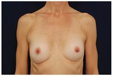 Breast Augmentation Before Photo by Michael Law, MD; Raleigh, NC - Case 28380