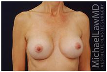 Breast Augmentation After Photo by Michael Law, MD; Raleigh, NC - Case 28380