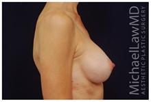 Breast Augmentation After Photo by Michael Law, MD; Raleigh, NC - Case 28380