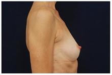 Breast Augmentation Before Photo by Michael Law, MD; Raleigh, NC - Case 28380