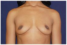 Breast Augmentation Before Photo by Michael Law, MD; Raleigh, NC - Case 28381