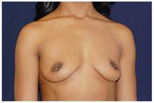 Breast Augmentation Before Photo by Michael Law, MD; Raleigh, NC - Case 28381