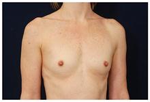 Breast Augmentation Before Photo by Michael Law, MD; Raleigh, NC - Case 28382