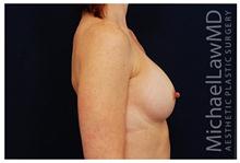 Breast Augmentation After Photo by Michael Law, MD; Raleigh, NC - Case 28382
