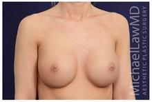 Breast Augmentation After Photo by Michael Law, MD; Raleigh, NC - Case 28383