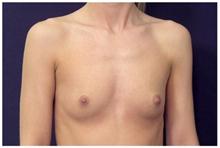 Breast Augmentation Before Photo by Michael Law, MD; Raleigh, NC - Case 28383