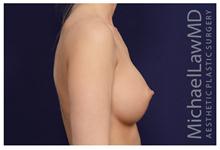 Breast Augmentation After Photo by Michael Law, MD; Raleigh, NC - Case 28383