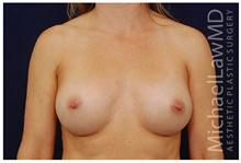 Breast Augmentation After Photo by Michael Law, MD; Raleigh, NC - Case 28403