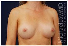 Breast Augmentation After Photo by Michael Law, MD; Raleigh, NC - Case 28403