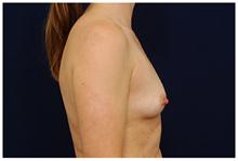 Breast Augmentation Before Photo by Michael Law, MD; Raleigh, NC - Case 28403