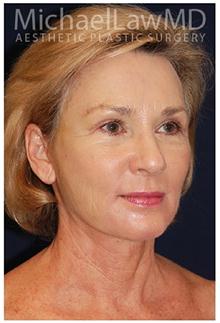 Facelift After Photo by Michael Law, MD; Raleigh, NC - Case 28412