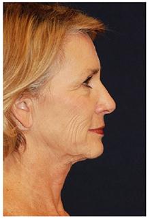 Facelift Before Photo by Michael Law, MD; Raleigh, NC - Case 28412