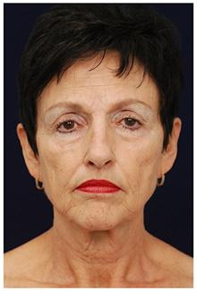 Facelift Before Photo by Michael Law, MD; Raleigh, NC - Case 28414
