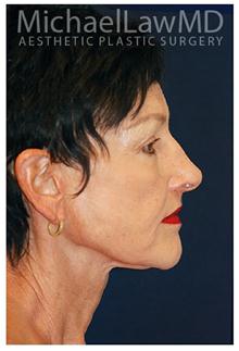 Facelift After Photo by Michael Law, MD; Raleigh, NC - Case 28414