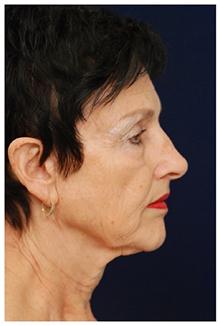 Facelift Before Photo by Michael Law, MD; Raleigh, NC - Case 28414