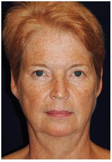 Facelift Before Photo by Michael Law, MD; Raleigh, NC - Case 28416
