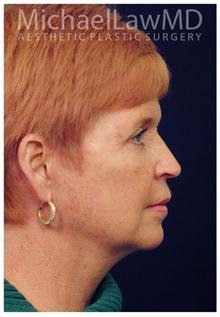 Facelift After Photo by Michael Law, MD; Raleigh, NC - Case 28416
