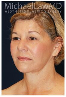 Facelift After Photo by Michael Law, MD; Raleigh, NC - Case 28418