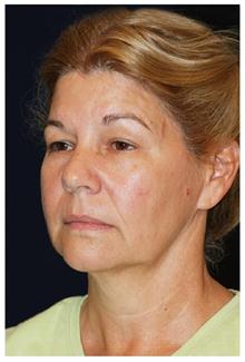 Facelift Before Photo by Michael Law, MD; Raleigh, NC - Case 28418