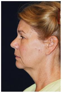 Facelift Before Photo by Michael Law, MD; Raleigh, NC - Case 28418