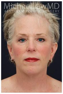 Facelift After Photo by Michael Law, MD; Raleigh, NC - Case 28419