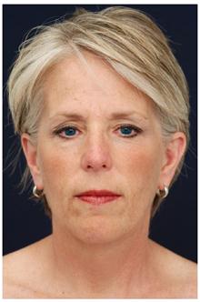 Facelift Before Photo by Michael Law, MD; Raleigh, NC - Case 28419