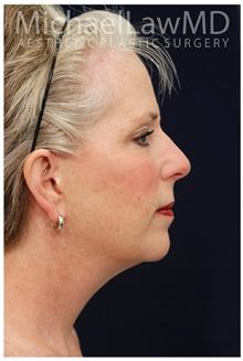 Facelift After Photo by Michael Law, MD; Raleigh, NC - Case 28419