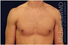 Male Breast Reduction After Photo by Michael Law, MD; Raleigh, NC - Case 28423