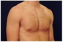 Male Breast Reduction Before Photo by Michael Law, MD; Raleigh, NC - Case 28423