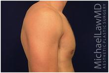 Male Breast Reduction After Photo by Michael Law, MD; Raleigh, NC - Case 28423
