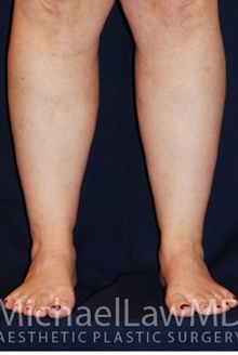Liposuction After Photo by Michael Law, MD; Raleigh, NC - Case 28425