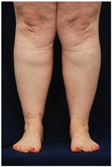 Liposuction Before Photo by Michael Law, MD; Raleigh, NC - Case 28425