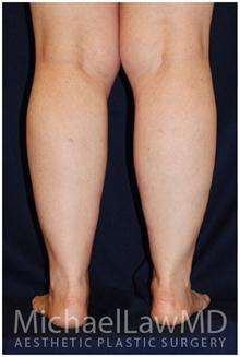 Liposuction After Photo by Michael Law, MD; Raleigh, NC - Case 28425