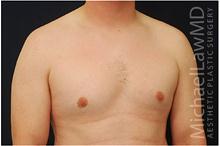 Male Breast Reduction After Photo by Michael Law, MD; Raleigh, NC - Case 28440