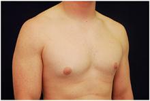 Male Breast Reduction Before Photo by Michael Law, MD; Raleigh, NC - Case 28440