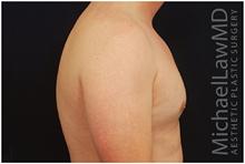 Male Breast Reduction After Photo by Michael Law, MD; Raleigh, NC - Case 28440