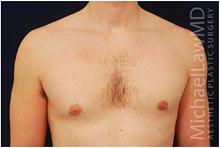 Male Breast Reduction After Photo by Michael Law, MD; Raleigh, NC - Case 28441