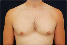 Male Breast Reduction Before Photo by Michael Law, MD; Raleigh, NC - Case 28441