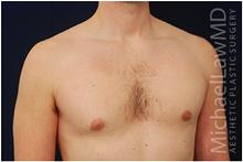Male Breast Reduction After Photo by Michael Law, MD; Raleigh, NC - Case 28441