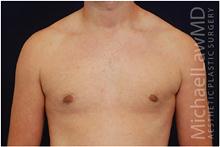 Male Breast Reduction After Photo by Michael Law, MD; Raleigh, NC - Case 28442