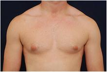 Male Breast Reduction Before Photo by Michael Law, MD; Raleigh, NC - Case 28442