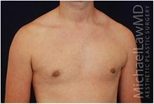 Male Breast Reduction After Photo by Michael Law, MD; Raleigh, NC - Case 28442
