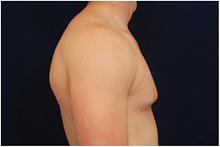 Male Breast Reduction Before Photo by Michael Law, MD; Raleigh, NC - Case 28442