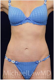 Tummy Tuck After Photo by Michael Law, MD; Raleigh, NC - Case 28443