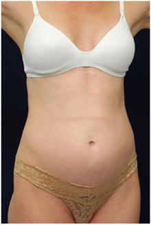 Tummy Tuck Before Photo by Michael Law, MD; Raleigh, NC - Case 28443